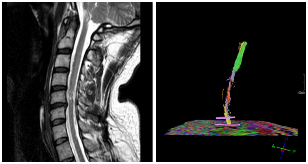 Fig. 1. 41 y.o. male with spinal cord infarction C4-Th1 after embolization of a spinal arteriovenous malformation. Patient had tetraparesis AIS D. Tibial SSEP and MEP from lower limbs and left arm were absent. MEPs from the right arm were delayed. MR DTI shows rarefied fiber tracts at the level of injury.