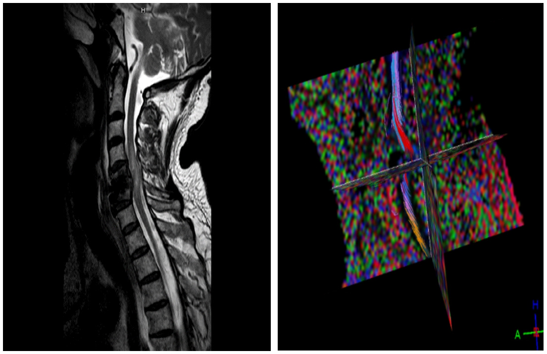 Fig. 3. 65 y.o. male with compressive myelopathy C3-C7 following epidural abscess and spinal stabilization and cage implantation at C5 and C6. Patient had tetraparesis AIS D. Tibial SSEPs were delayed, MEPs were not tested. In MR DTI susceptibility artefacts due to vertebral cage implants caused significant geometric distortion.